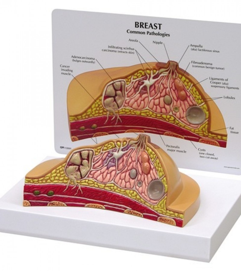 Breast Pathologies Anatomical Model